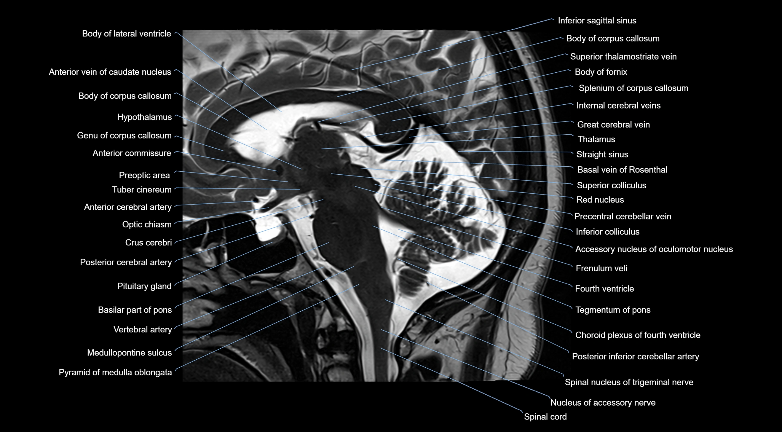MRI brainstem & basal ganglia anatomy labelled  3T MRI images -img-10001-00025.webp